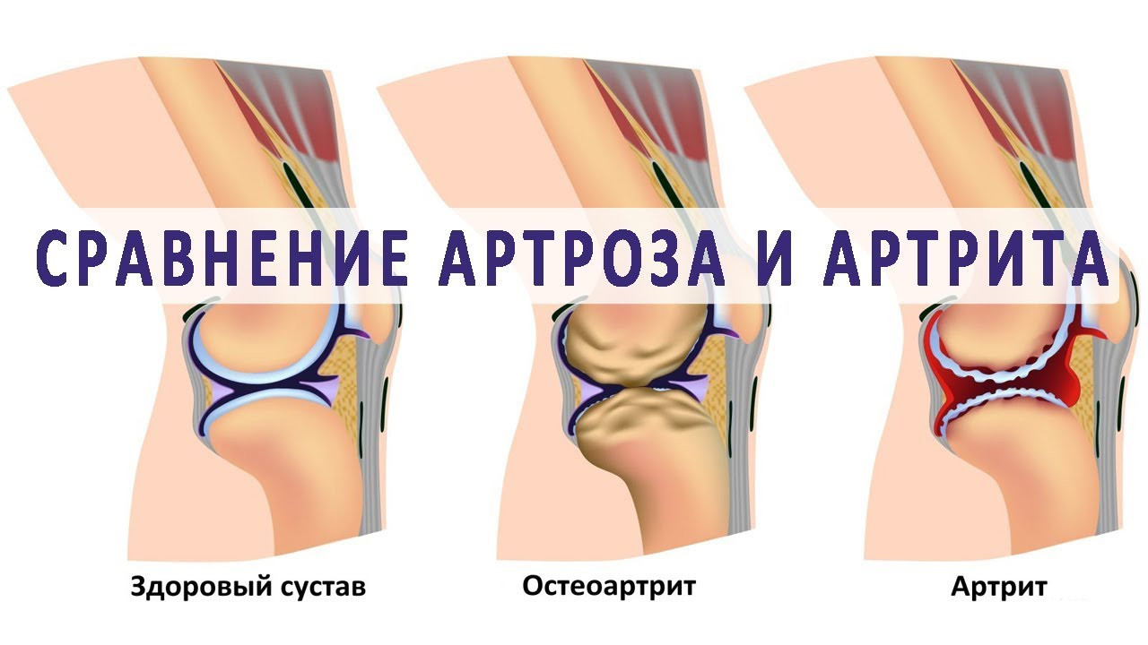 Артрит и артроз в чем. Разница между артритом и артрозом. Остеоартроз и артрит разница.