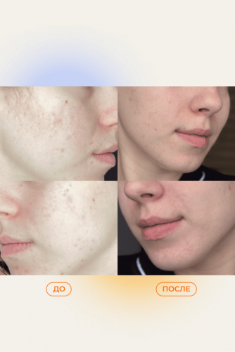 Cыворотка для работы с акне и пигментацией с 2% ниацинамида FELD APOTHEKE Phyto Calm Serum 30ml