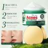 SADOER Крем для лица ACNES Oil Control Чайное Дерево 50г (SD-50873)